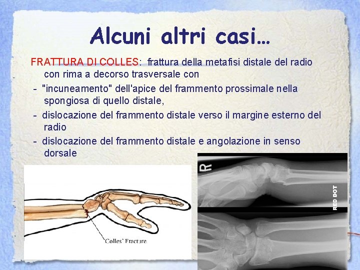 Alcuni altri casi… FRATTURA DI COLLES: frattura della metafisi distale del radio con rima