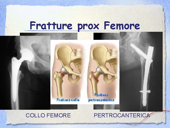 Fratture prox Femore COLLO FEMORE PERTROCANTERICA 