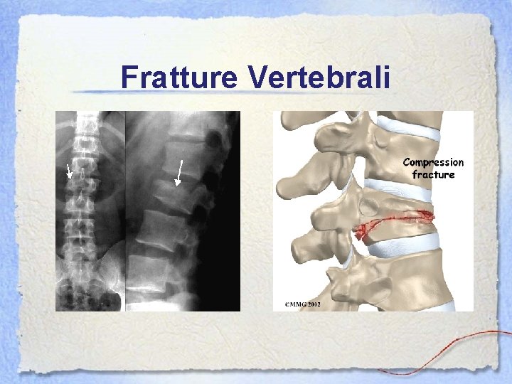 Fratture Vertebrali 