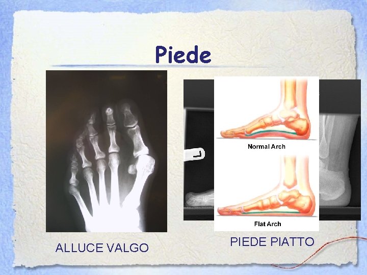 Piede ALLUCE VALGO PIEDE PIATTO 