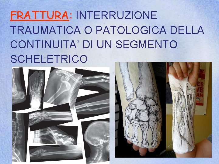 FRATTURA: INTERRUZIONE TRAUMATICA O PATOLOGICA DELLA CONTINUITA’ DI UN SEGMENTO SCHELETRICO 