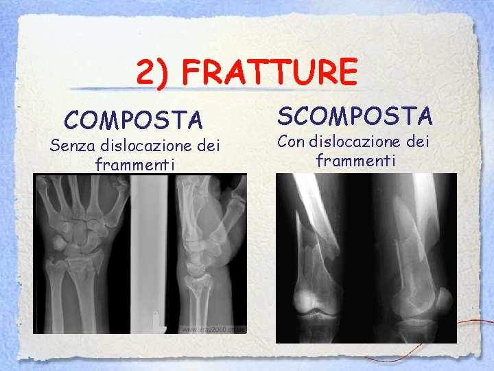 2) FRATTURE COMPOSTA Senza dislocazione dei frammenti SCOMPOSTA Con dislocazione dei frammenti 