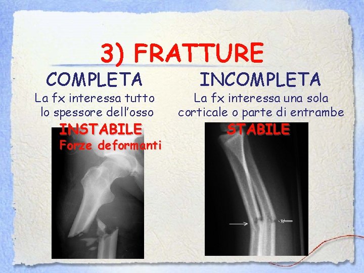 3) FRATTURE COMPLETA La fx interessa tutto lo spessore dell’osso INSTABILE Forze deformanti INCOMPLETA