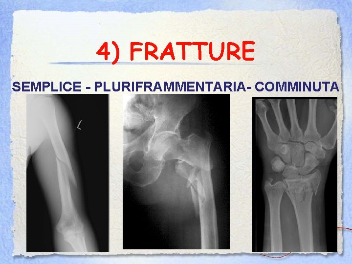 4) FRATTURE SEMPLICE - PLURIFRAMMENTARIA- COMMINUTA 