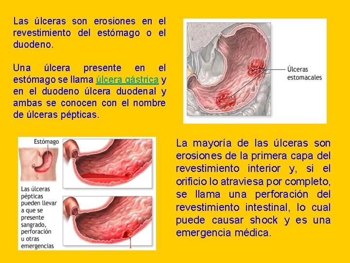 Las úlceras son erosiones en el revestimiento del estómago o el duodeno. Una úlcera