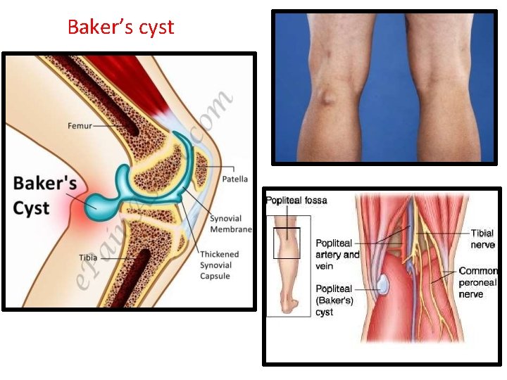 Baker’s cyst 