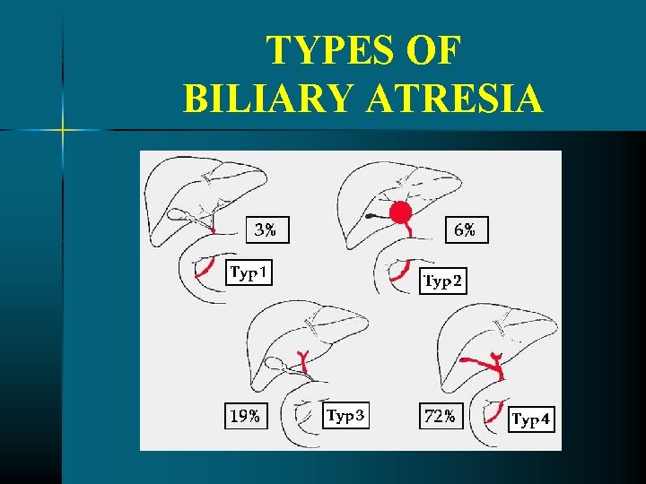 TYPES OF BILIARY ATRESIA TYPES OF BILIARY ATRESIA