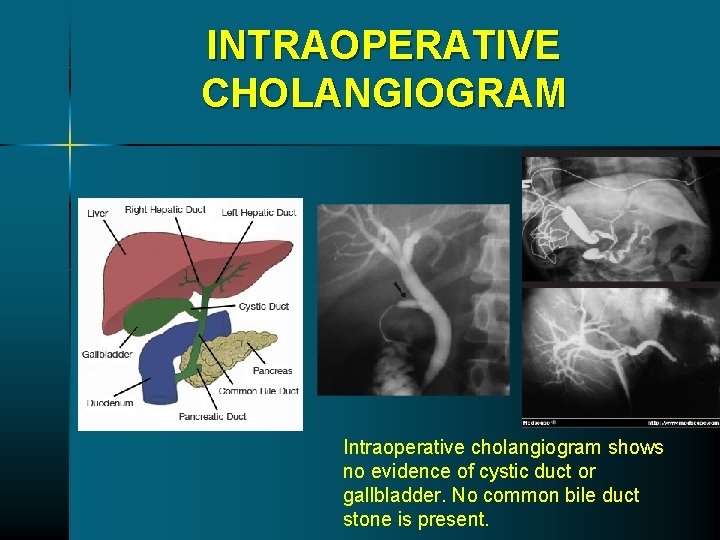 INTRAOPERATIVE CHOLANGIOGRAM Intraoperative cholangiogram shows no evidence of cystic duct or gallbladder. No common INTRAOPERATIVE CHOLANGIOGRAM Intraoperative cholangiogram shows no evidence of cystic duct or gallbladder. No common