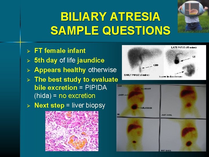 BILIARY ATRESIA SAMPLE QUESTIONS Ø Ø Ø FT female infant 5 th day of BILIARY ATRESIA SAMPLE QUESTIONS Ø Ø Ø FT female infant 5 th day of