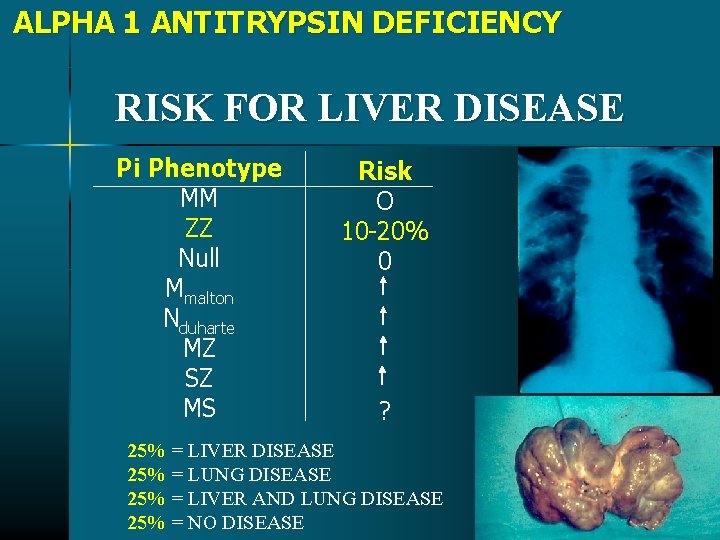 ALPHA 1 ANTITRYPSIN DEFICIENCY RISK FOR LIVER DISEASE Pi Phenotype MM ZZ Null Mmalton ALPHA 1 ANTITRYPSIN DEFICIENCY RISK FOR LIVER DISEASE Pi Phenotype MM ZZ Null Mmalton