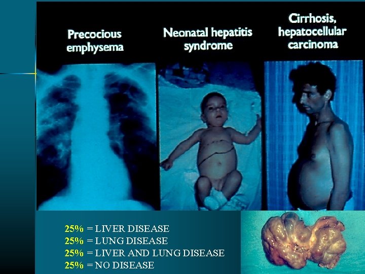 25% = LIVER DISEASE 25% = LUNG DISEASE 25% = LIVER AND LUNG DISEASE 25% = LIVER DISEASE 25% = LUNG DISEASE 25% = LIVER AND LUNG DISEASE