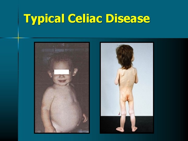 Typical Celiac Disease Typical Celiac Disease