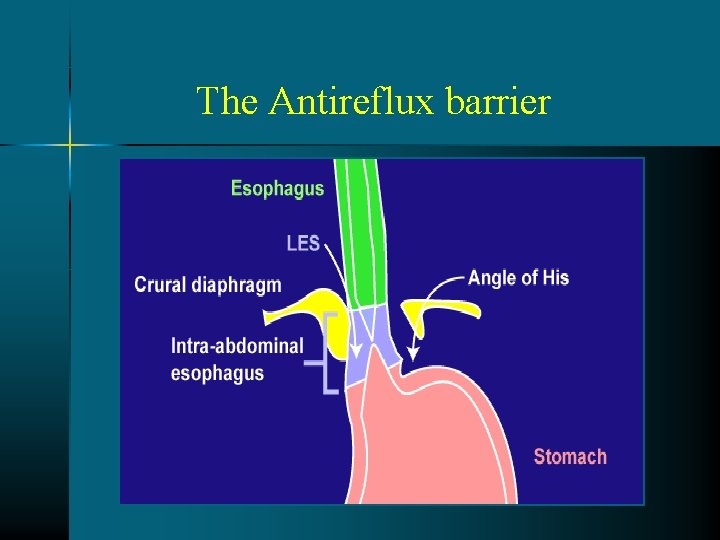 The Antireflux barrier The Antireflux barrier