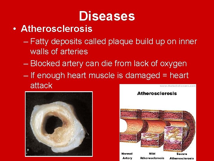 Diseases • Atherosclerosis – Fatty deposits called plaque build up on inner walls of