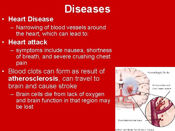 Diseases • Heart Disease – Narrowing of blood vessels around the heart, which can