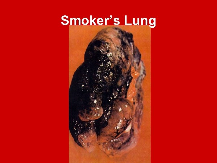 Smoker’s Lung 