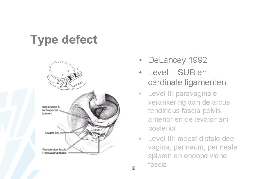 Type defect • De. Lancey 1992 • Level I: SUB en cardinale ligamenten •