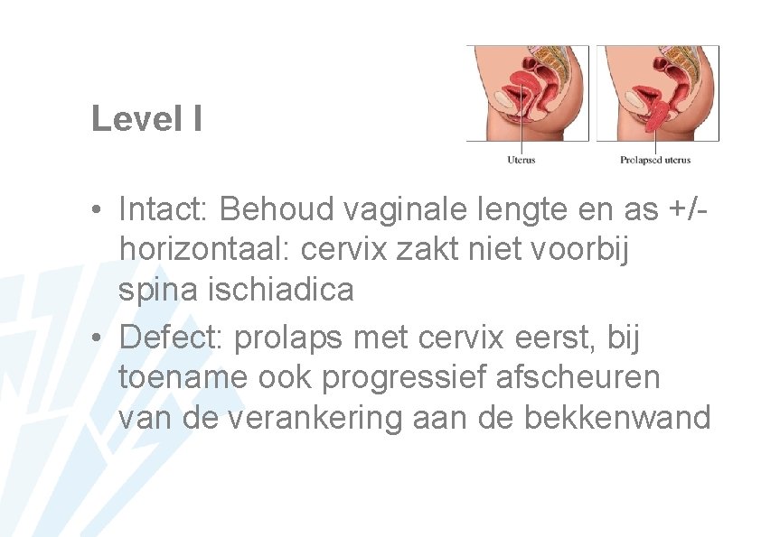 Level I • Intact: Behoud vaginale lengte en as +/horizontaal: cervix zakt niet voorbij