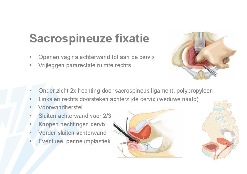 Sacrospineuze fixatie • • Openen vagina achterwand tot aan de cervix Vrijleggen pararectale ruimte
