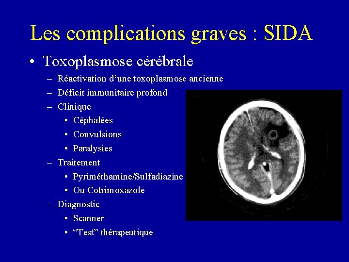 Les complications graves : SIDA • Toxoplasmose cérébrale – Réactivation d’une toxoplasmose ancienne –