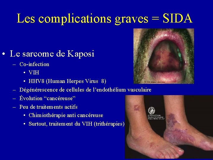 Les complications graves = SIDA • Le sarcome de Kaposi – Co-infection • VIH