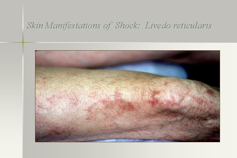 Skin Manifestations of Shock: Livedo reticularis 