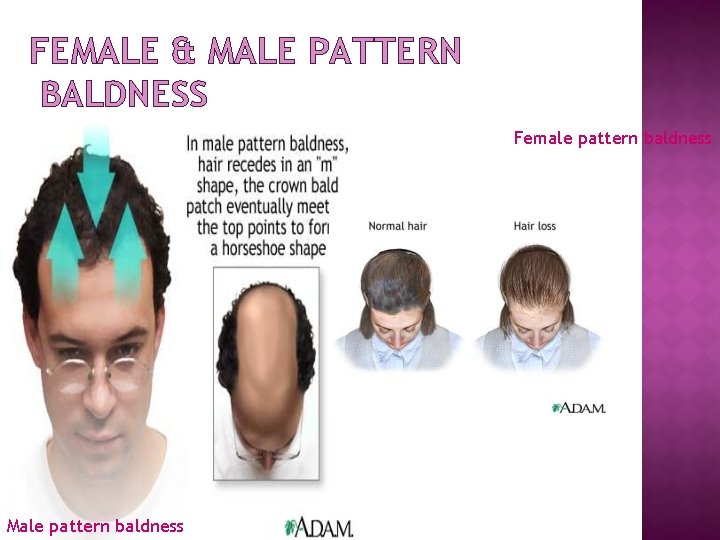 FEMALE & MALE PATTERN BALDNESS Female pattern baldness Male pattern baldness 