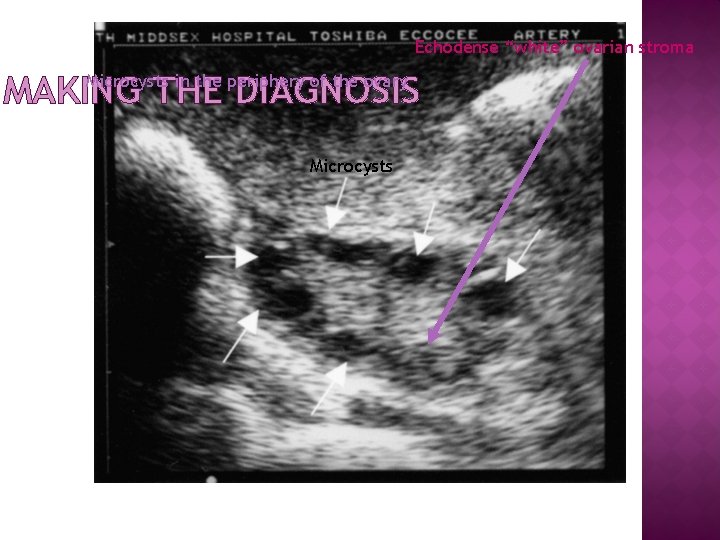 Echodense “white” ovarian stroma MAKING THE DIAGNOSIS Microcysts in the periphery of the ovary