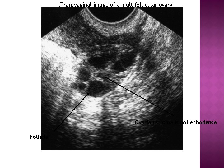 . Transvaginal image of a multifollicular ovary Ovarian stroma is not echodense Follicle 