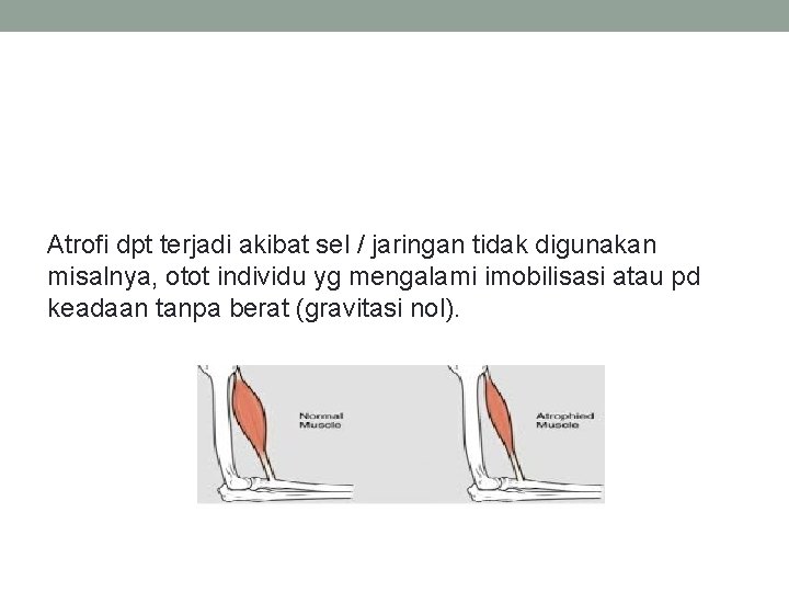 Atrofi dpt terjadi akibat sel / jaringan tidak digunakan misalnya, otot individu yg mengalami