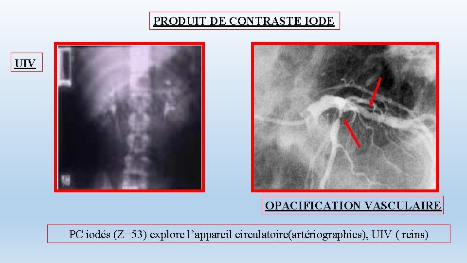 PRODUIT DE CONTRASTE IODE UIV OPACIFICATION VASCULAIRE PC iodés (Z=53) explore l’appareil circulatoire(artériographies), UIV