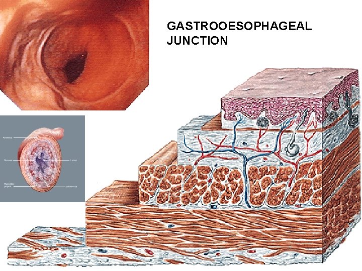 GASTROOESOPHAGEAL JUNCTION GASTROOESOPHAGEAL JUNCTION