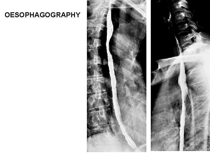 OESOPHAGOGRAPHY OESOPHAGOGRAPHY