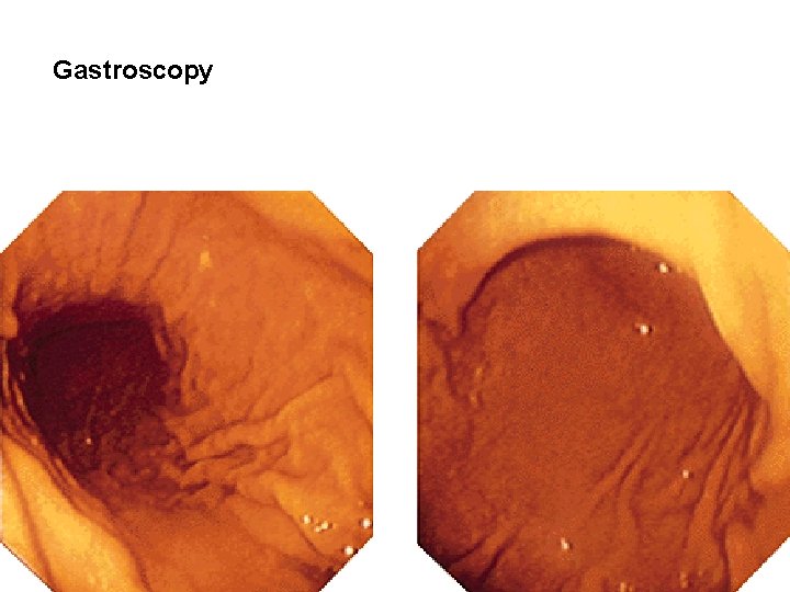 Gastroscopy Gastroscopy