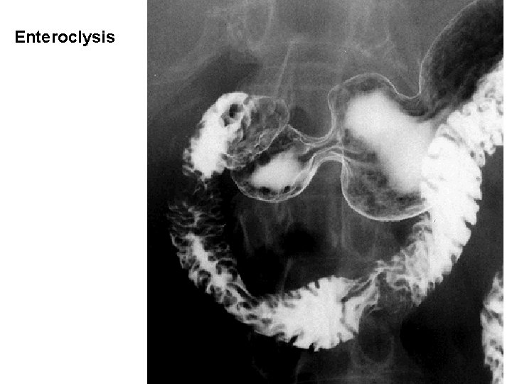 Enteroclysis Enteroclysis