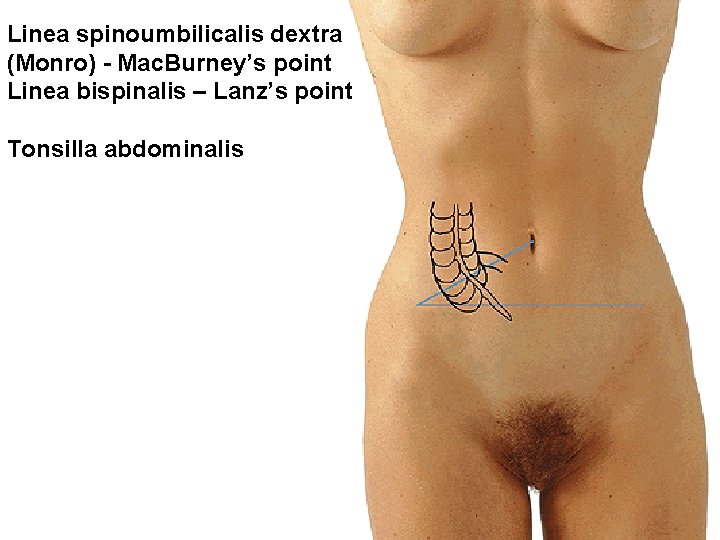 Linea spinoumbilicalis dextra (Monro) - Mac. Burney’s point Linea bispinalis – Lanz’s point Tonsilla Linea spinoumbilicalis dextra (Monro) - Mac. Burney’s point Linea bispinalis – Lanz’s point Tonsilla