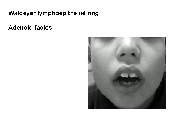 Waldeyer lymphoepithelial ring Adenoid facies Waldeyer lymphoepithelial ring Adenoid facies