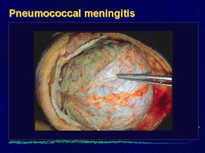 Pneumococcal meningitis 