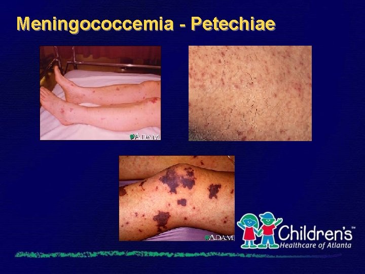 Meningococcemia - Petechiae 