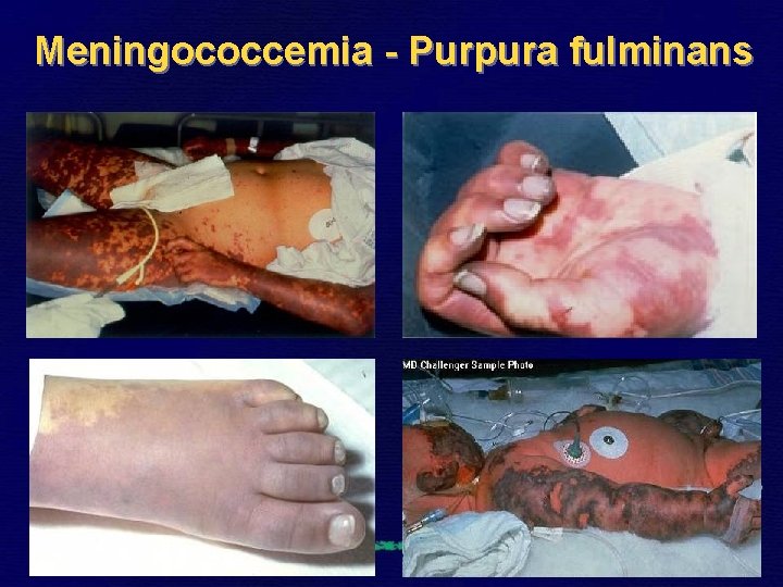 Meningococcemia - Purpura fulminans 