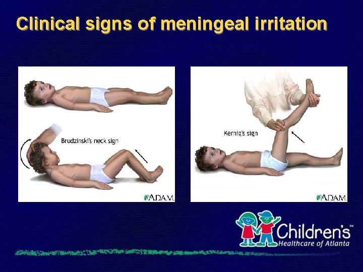 Clinical signs of meningeal irritation 