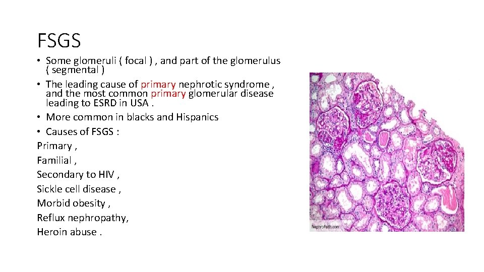 FSGS • Some glomeruli ( focal ) , and part of the glomerulus (