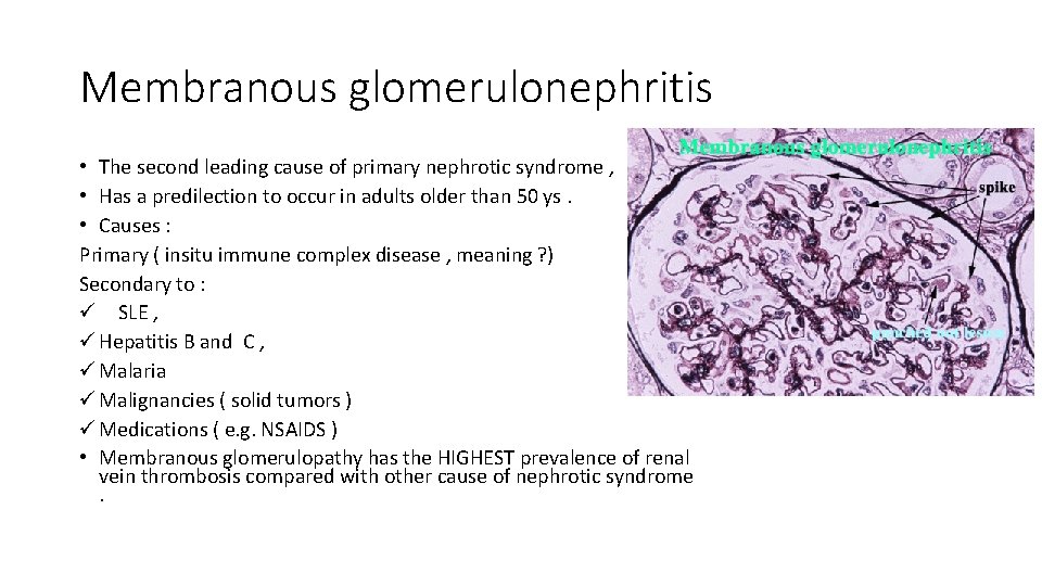Membranous glomerulonephritis • The second leading cause of primary nephrotic syndrome , • Has