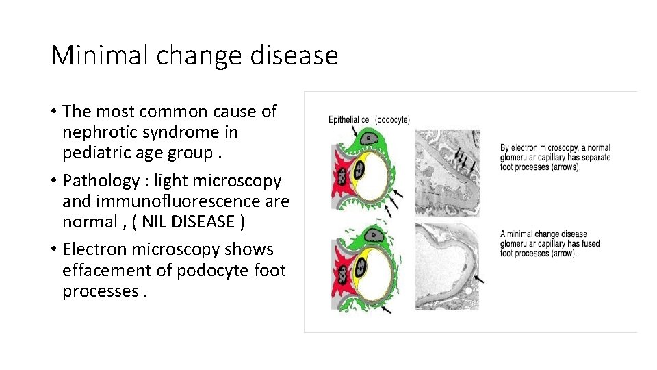 Minimal change disease • The most common cause of nephrotic syndrome in pediatric age