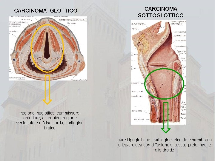 CARCINOMA GLOTTICO CARCINOMA SOTTOGLOTTICO regione ipoglottica, commissura anteriore, aritenoide, regione ventricolare e falsa corda,