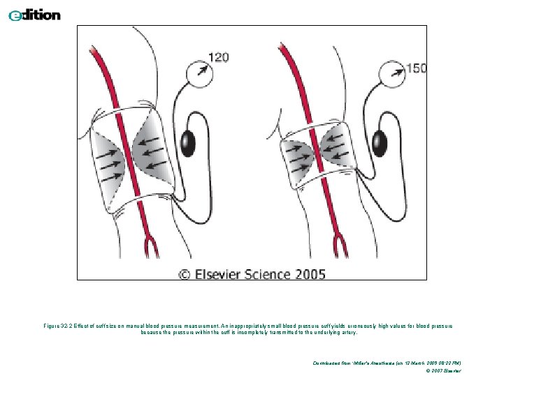 Figure 32 -2 Effect of cuff size on manual blood pressure measurement. An inappropriately Figure 32 -2 Effect of cuff size on manual blood pressure measurement. An inappropriately