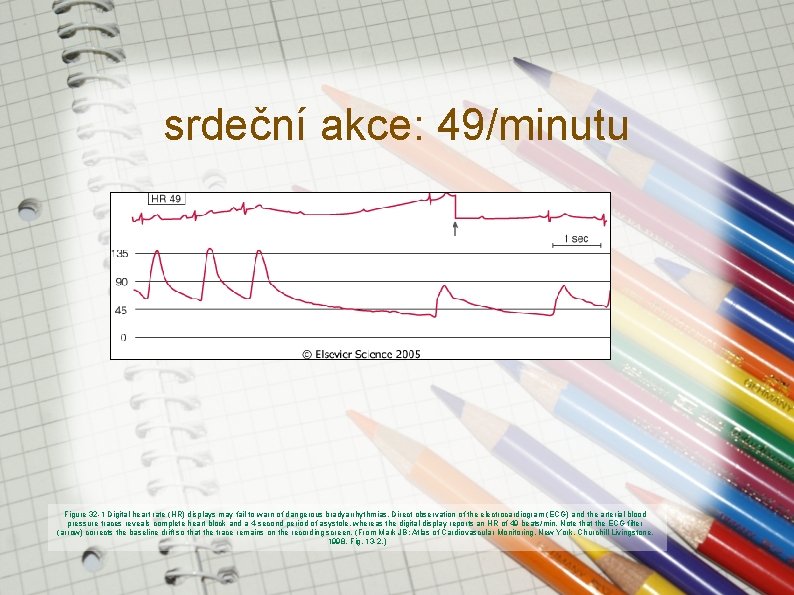 srdeční akce: 49/minutu Figure 32 -1 Digital heart rate (HR) displays may fail to srdeční akce: 49/minutu Figure 32 -1 Digital heart rate (HR) displays may fail to