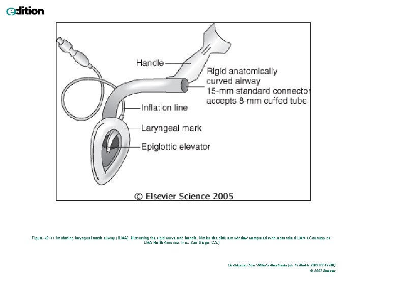 Figure 42 -11 Intubating laryngeal mask airway (ILMA), illustrating the rigid curve and handle. Figure 42 -11 Intubating laryngeal mask airway (ILMA), illustrating the rigid curve and handle.