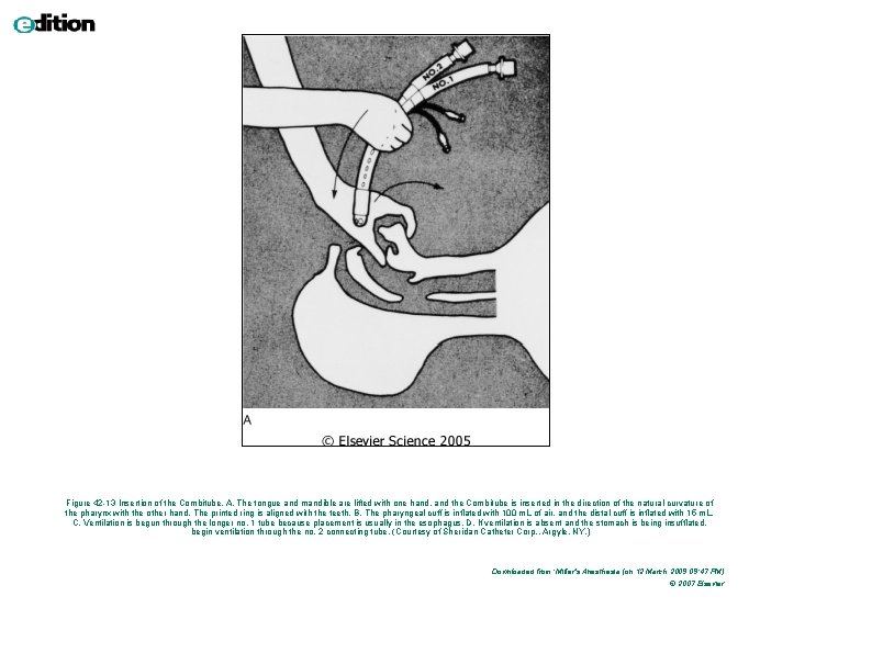 Figure 42 -13 Insertion of the Combitube. A, The tongue and mandible are lifted Figure 42 -13 Insertion of the Combitube. A, The tongue and mandible are lifted