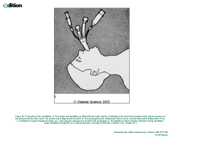 Figure 42 -13 Insertion of the Combitube. A, The tongue and mandible are lifted Figure 42 -13 Insertion of the Combitube. A, The tongue and mandible are lifted